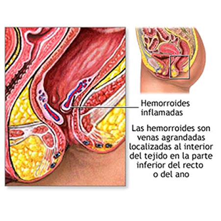 9.4 Hemorroides